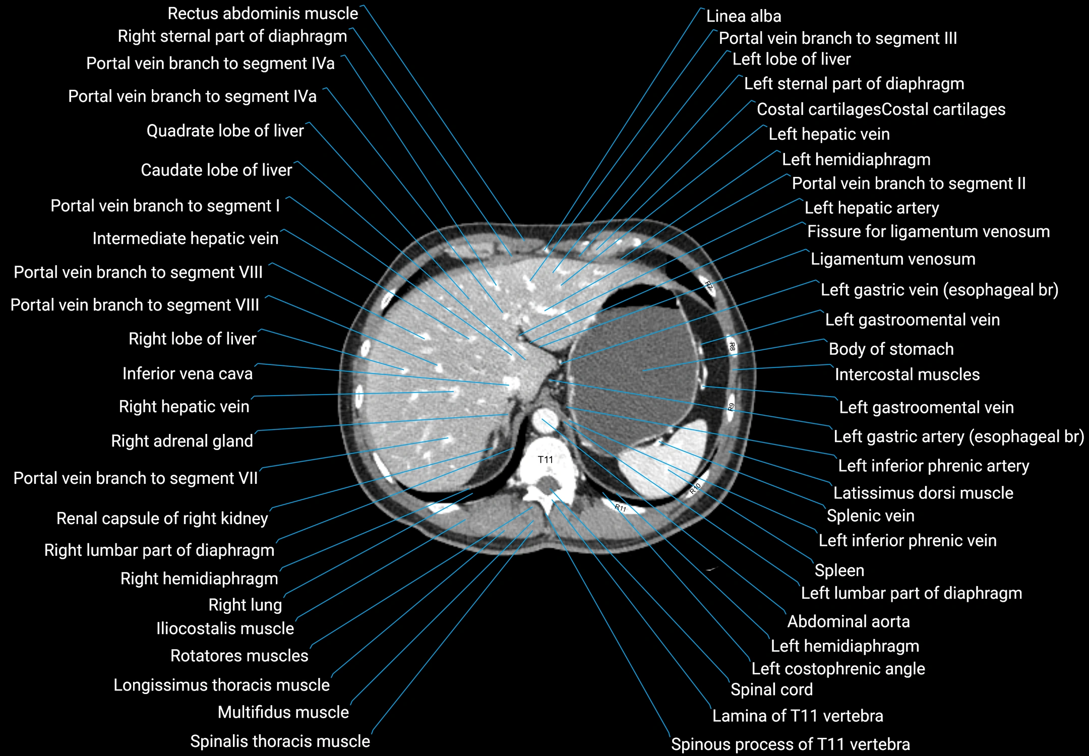 CT male pelvis axial cross sectional anatomy labelled radiology image -00030.webp